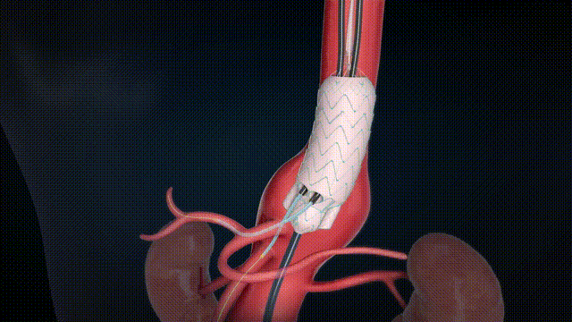 G-Branch 分支沉建+髂内开释（深色无字幕20s）2024.10.11 00_00_00-00_00_30.gif